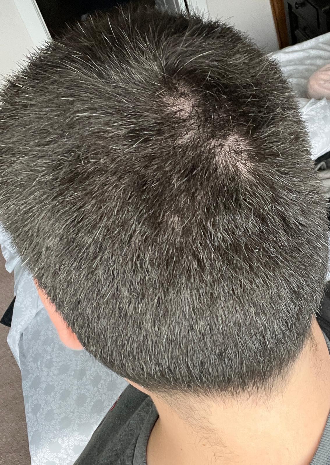 The top and back of my head from above, showing two thinner patches near the crown